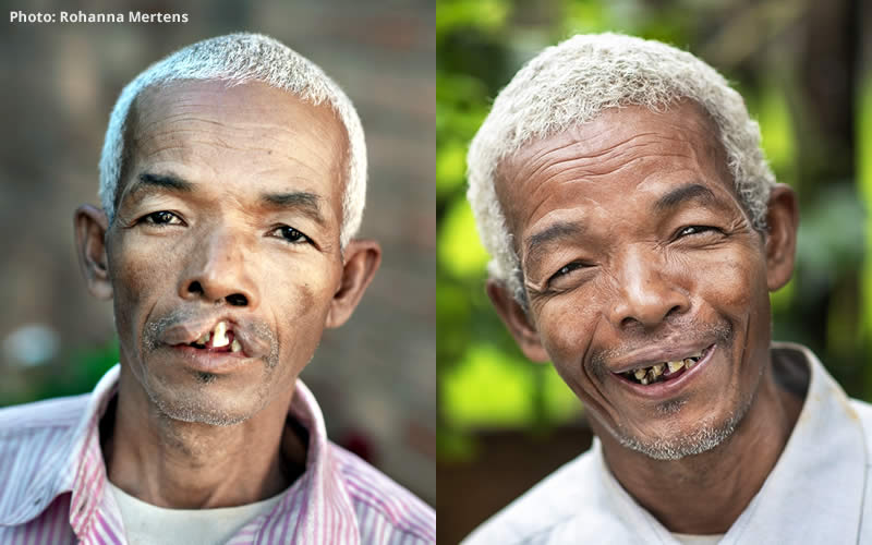 After 50 years living with a cleft lip, Alfred never expected his life to change