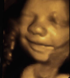 3-d ultrasound scan