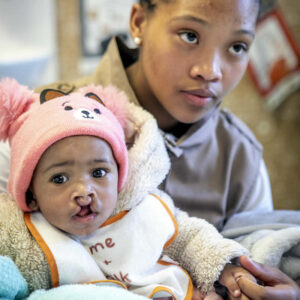 baby born with a cleft lip