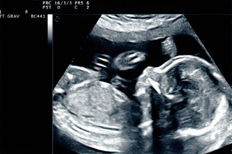 ultrasound scan