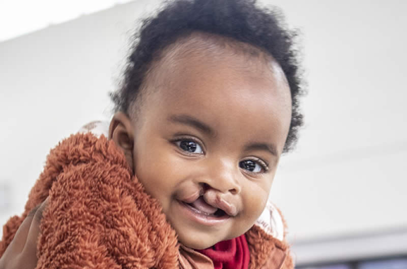 Birth defects - cleft lip