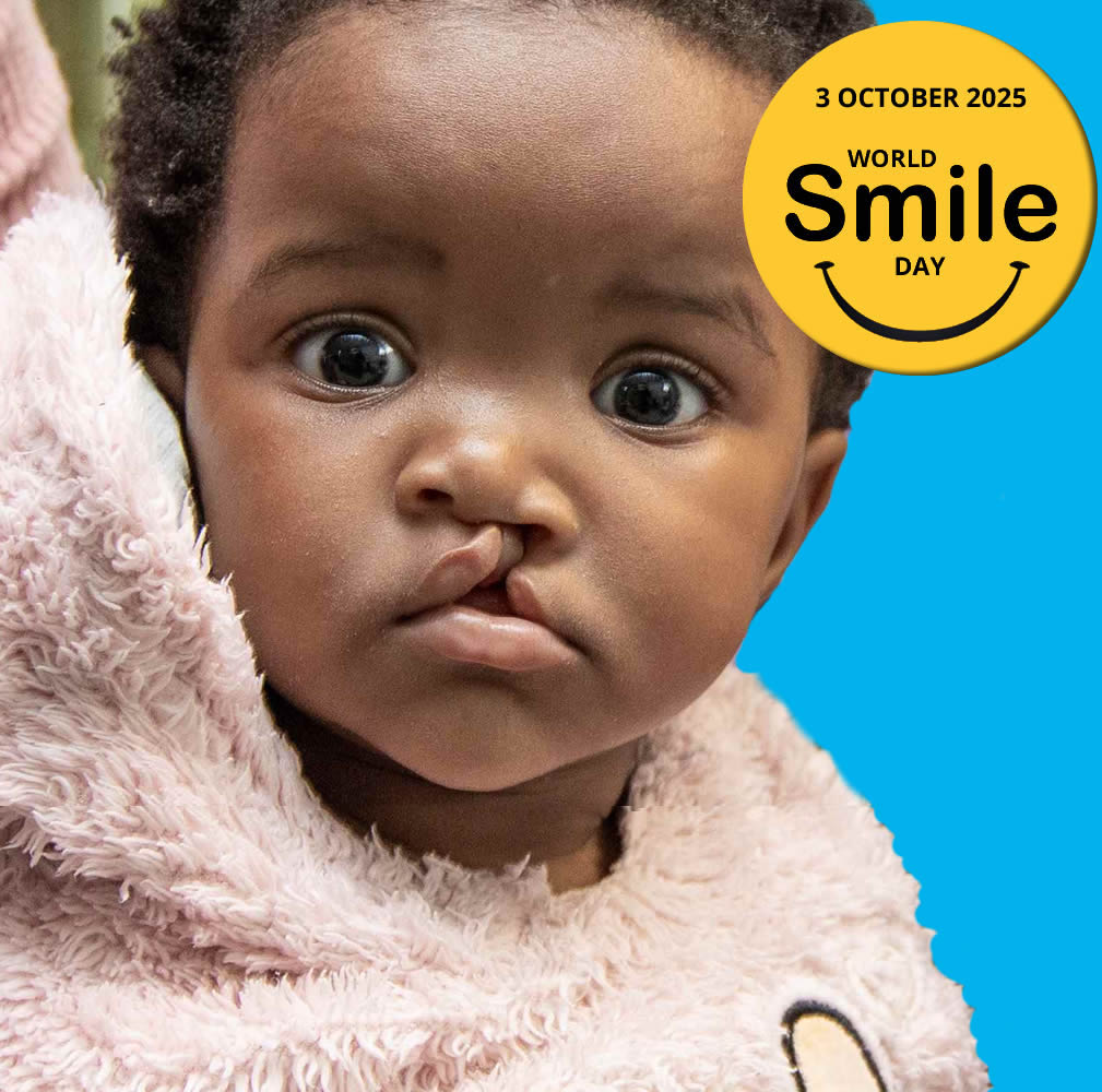 Child with cleft