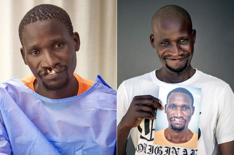 Zivezile update – a life transformed by cleft surgery