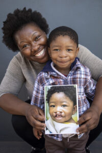 One year after cleft lip surgery, Nzulu has a beautiful new smile.