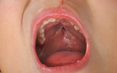 Dental obturators – what are they and what do they do?