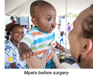 Mpelo before surgery