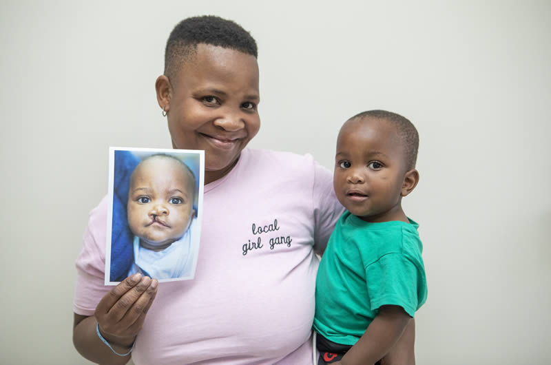 Cleft surgery