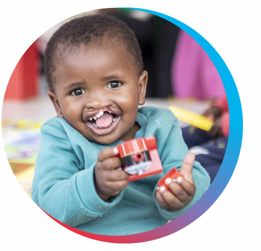 child with cleft