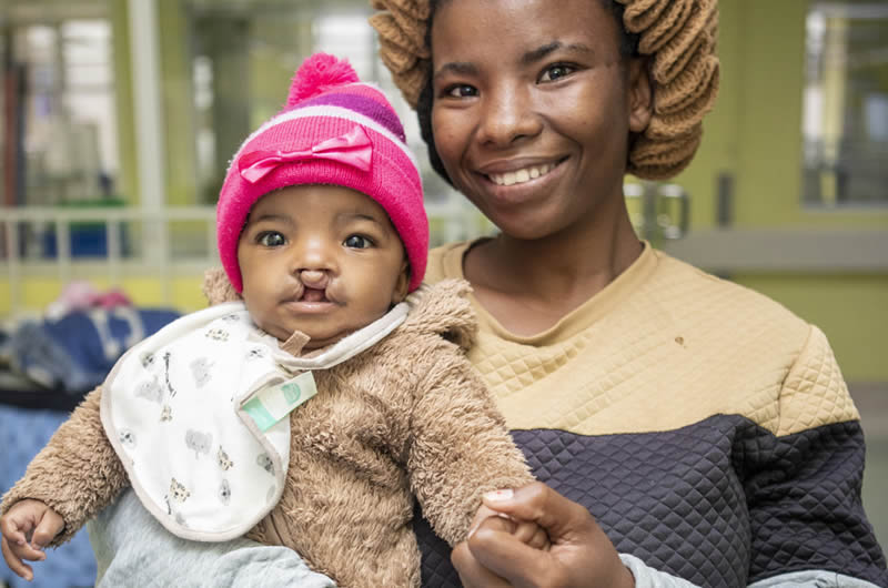 Baby with cleft lip